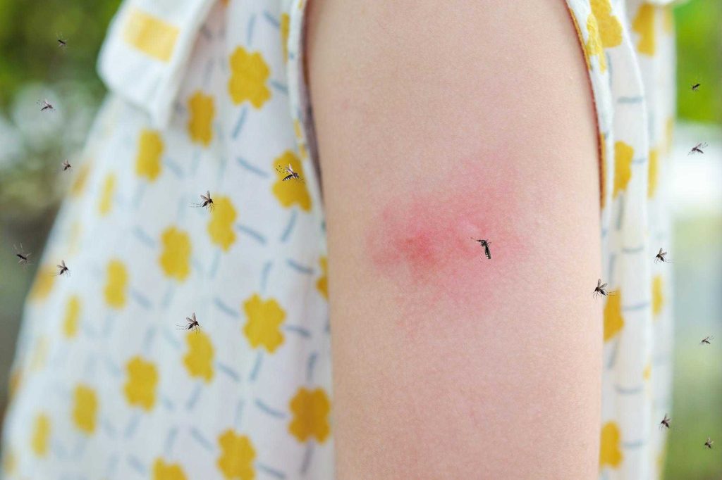 mosquito biting